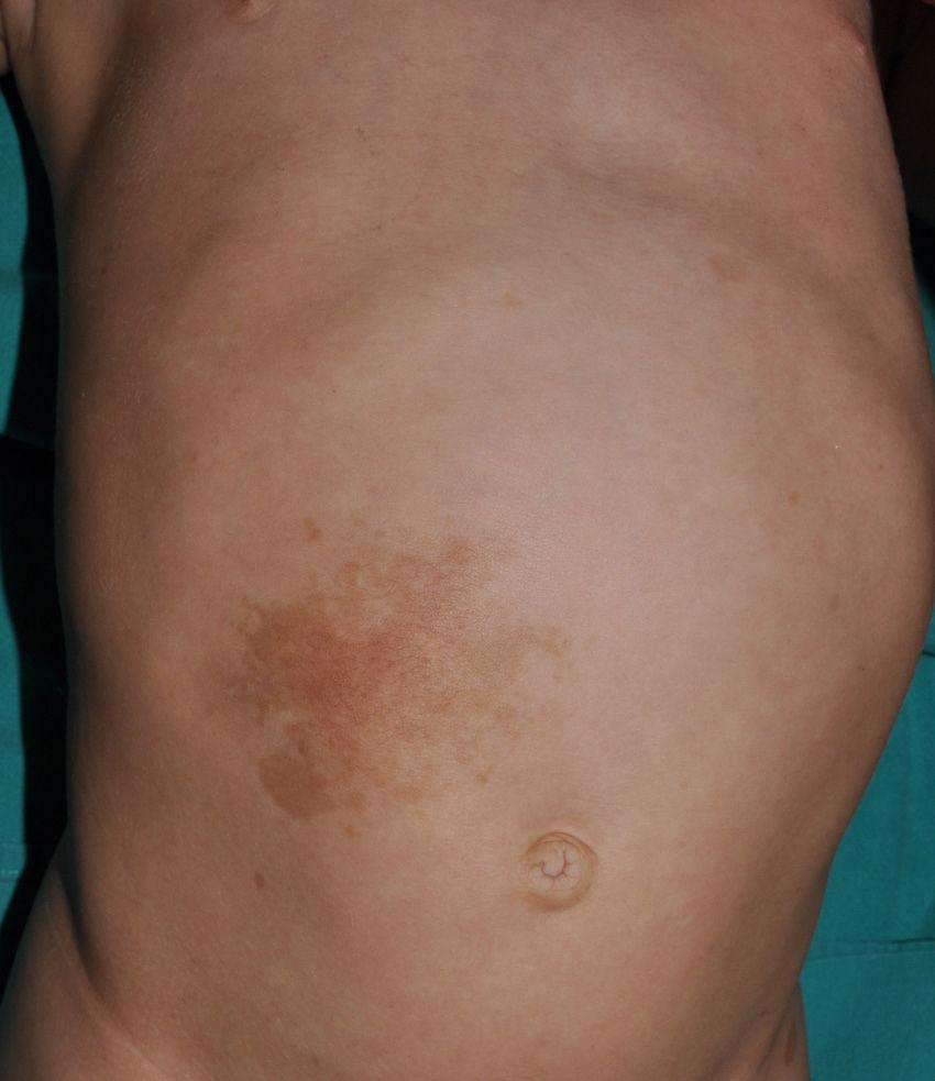 Plexiform Neurofibroma