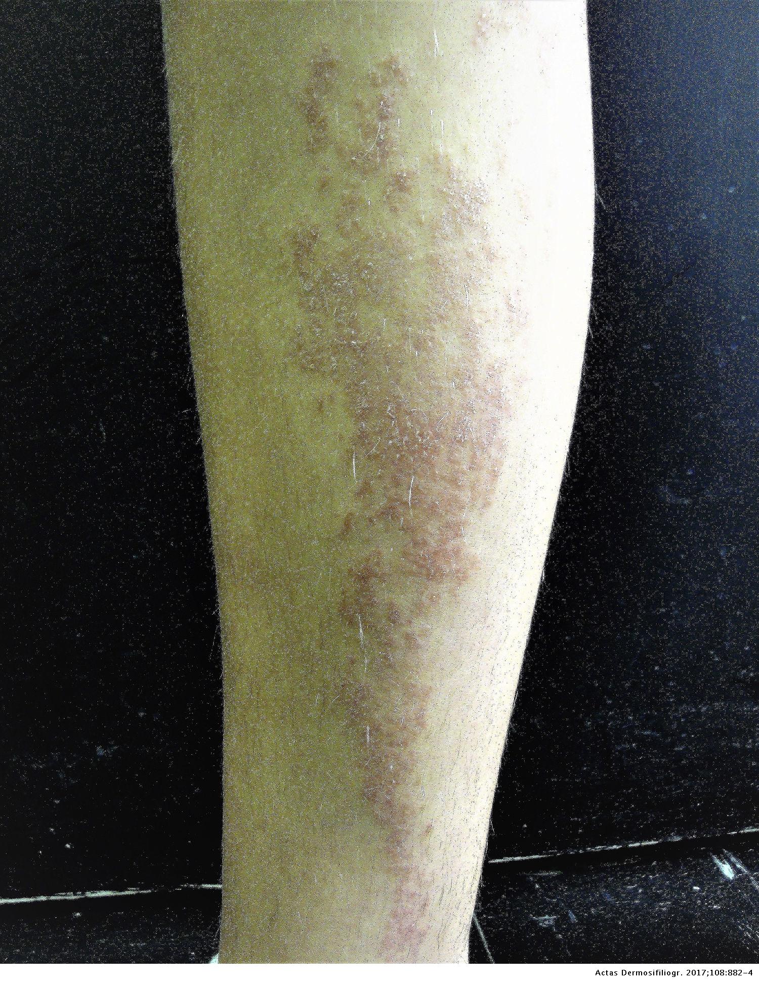 Lichen Striatus in Childhood: Is It Associated With Atopic Dermatitis ...