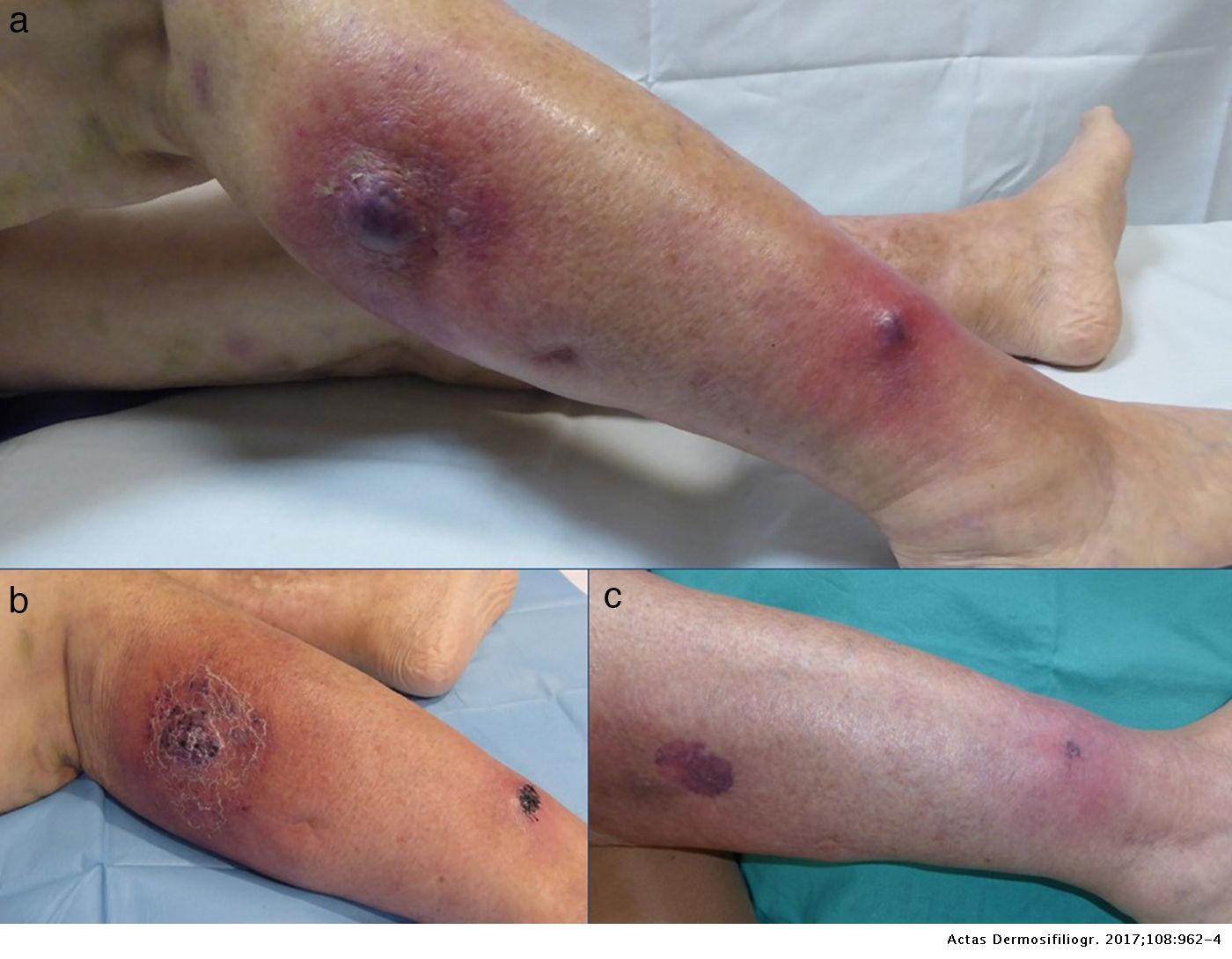 Early Pyoderma Gangrenosum