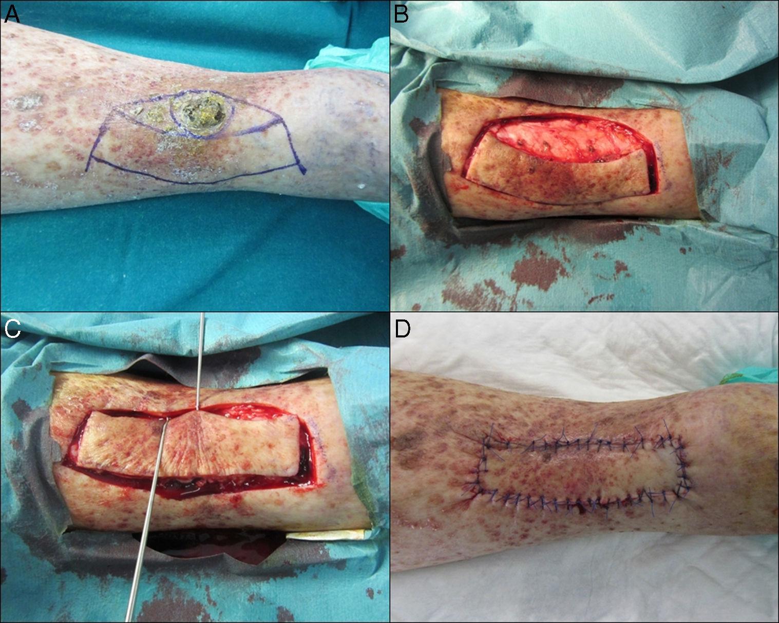 The Keystone Flap in Dermatology Clinical Experience with 18 Patients Actas DermoSifiliográficas