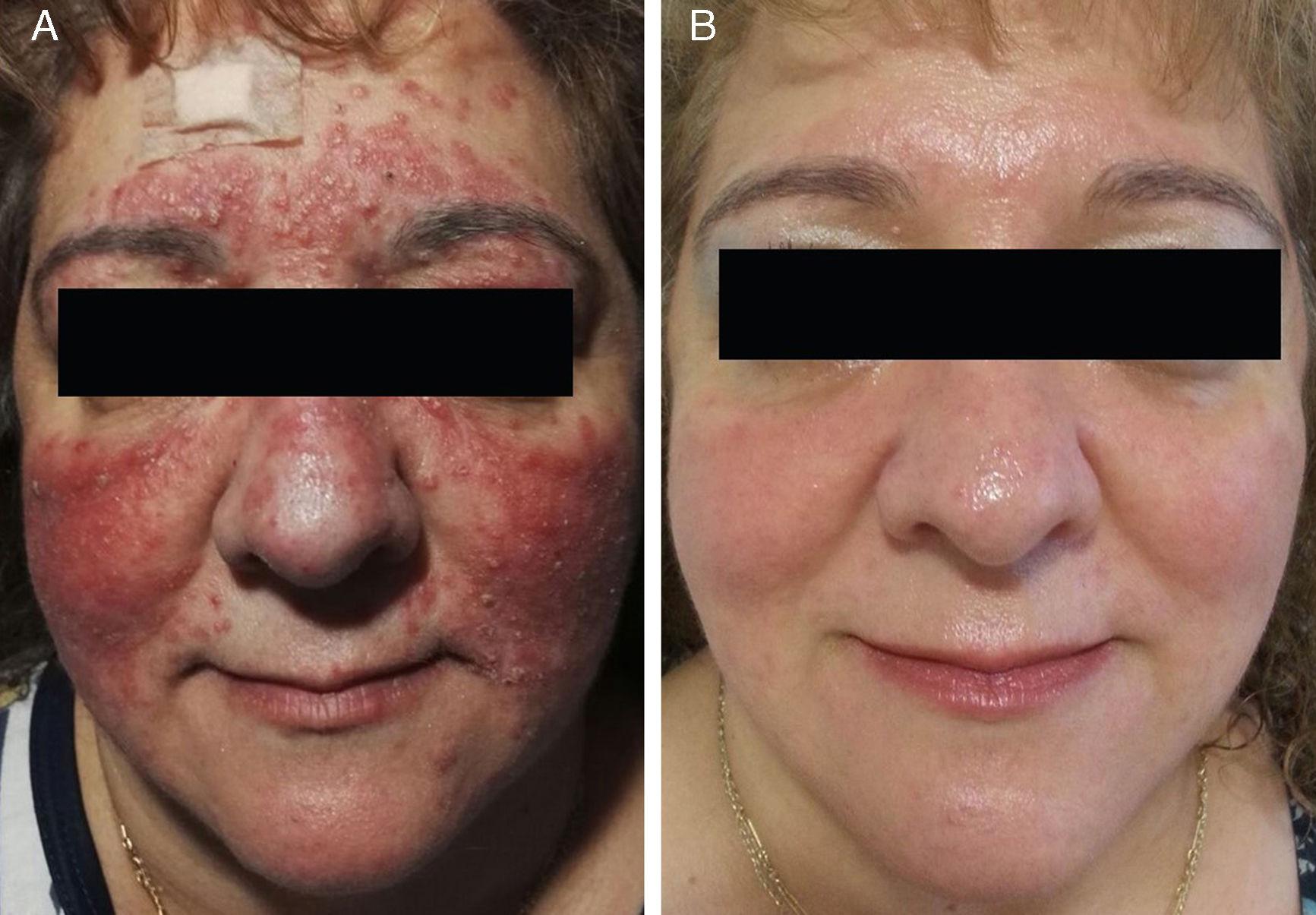 red light therapy for papulopustular rosacea