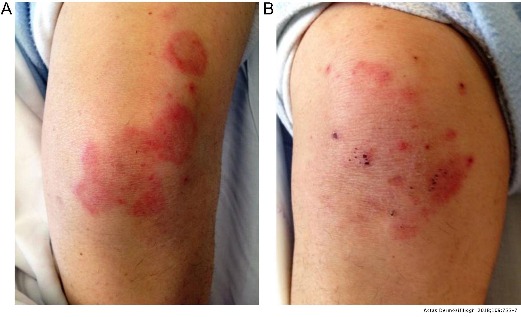 Erythema Annulare Centrifugum Thigh