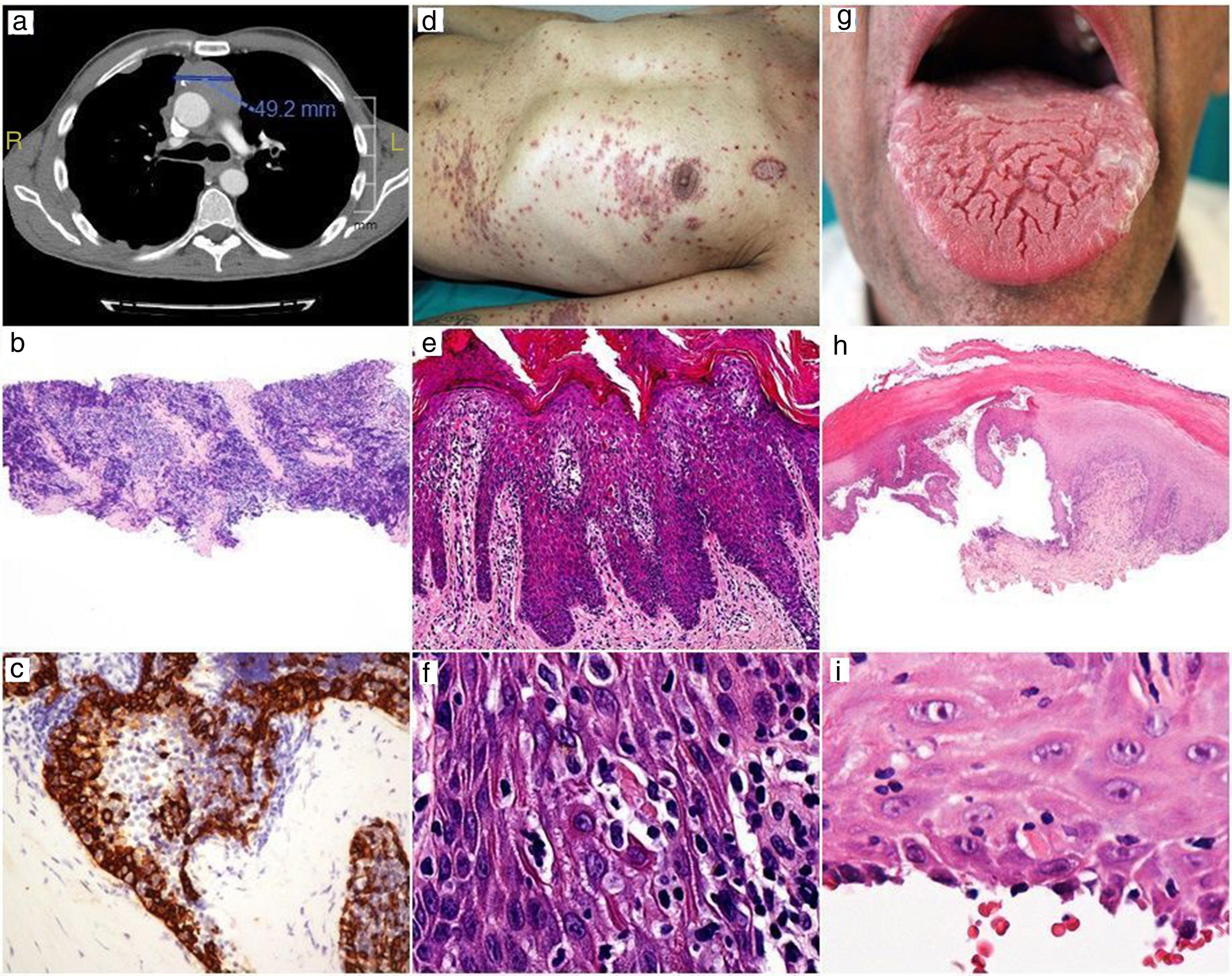 AdvancedStage Thymoma Associating Multiple Paraneoplastic Syndromes