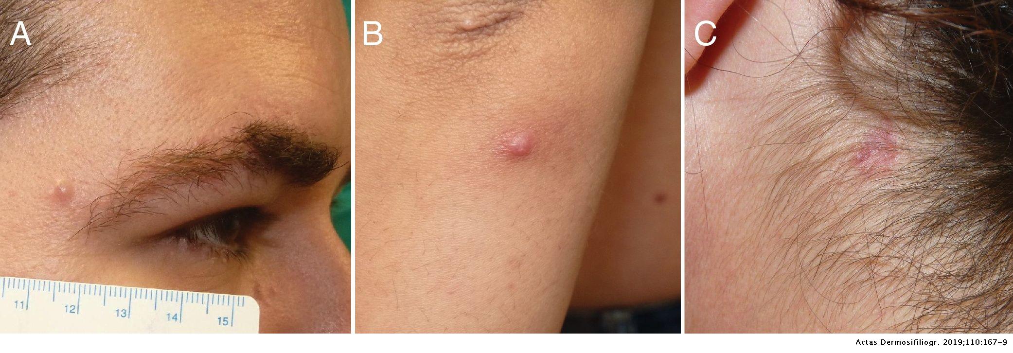 Langerhans Cell Histiocytosis Skin