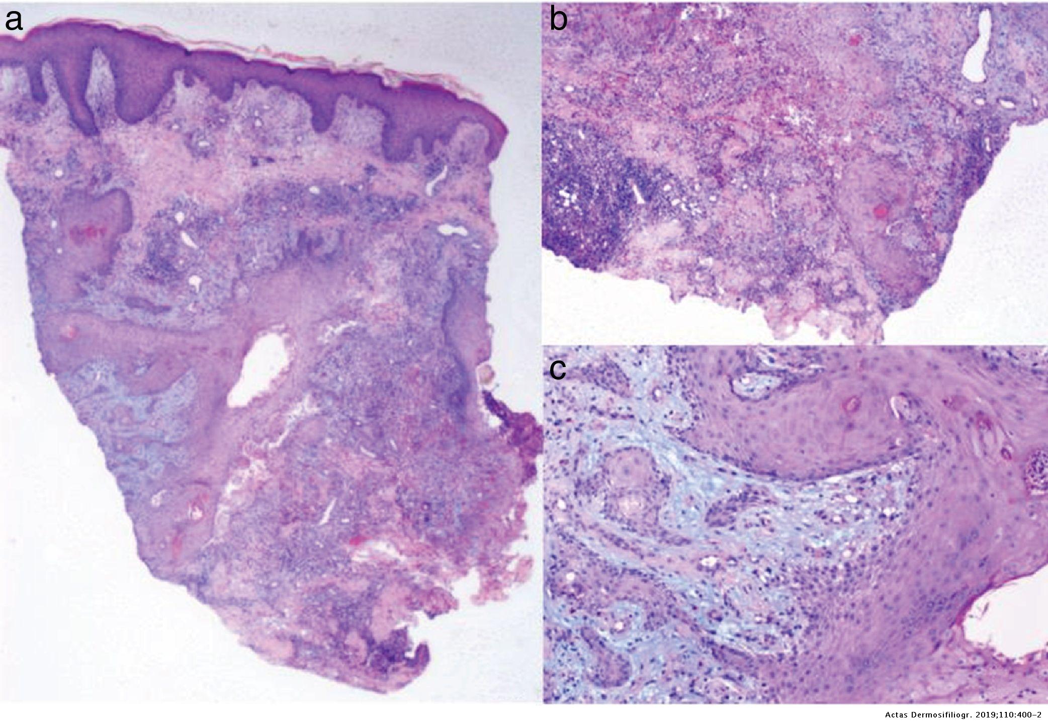 Pyoderma Gangrenosum Mimicking a Squamous Cell Carcinoma | Actas Dermo ...