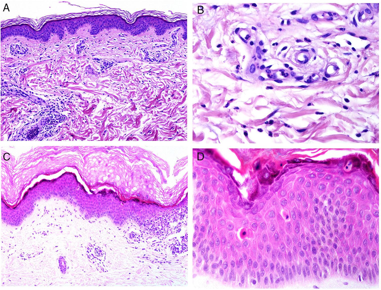 Skin Biopsy in the Context of Systemic Disease Actas Dermo