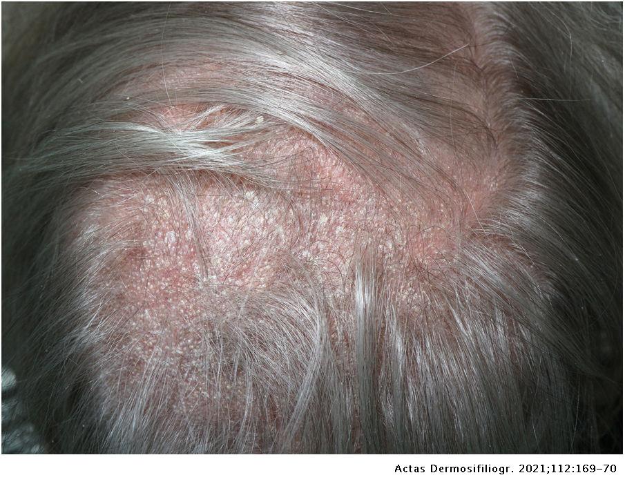 Erythematous Scaly Plaque | Actas Dermo-Sifiliográficas