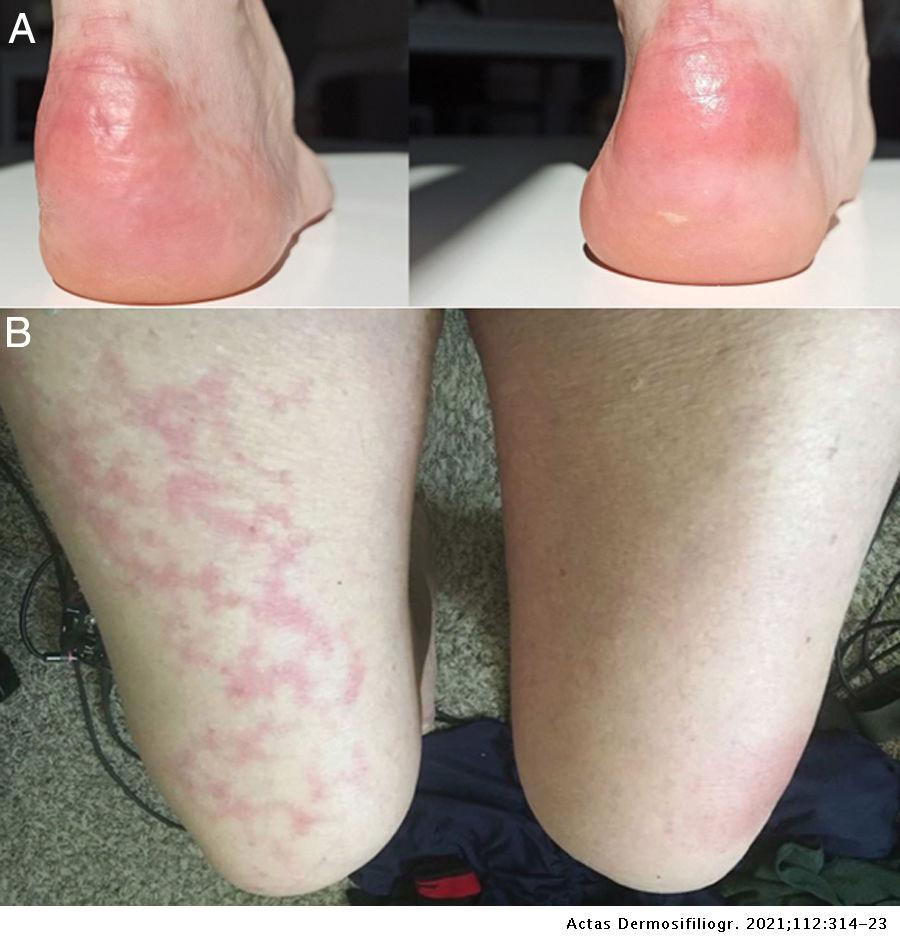 Mild Livedo Reticularis