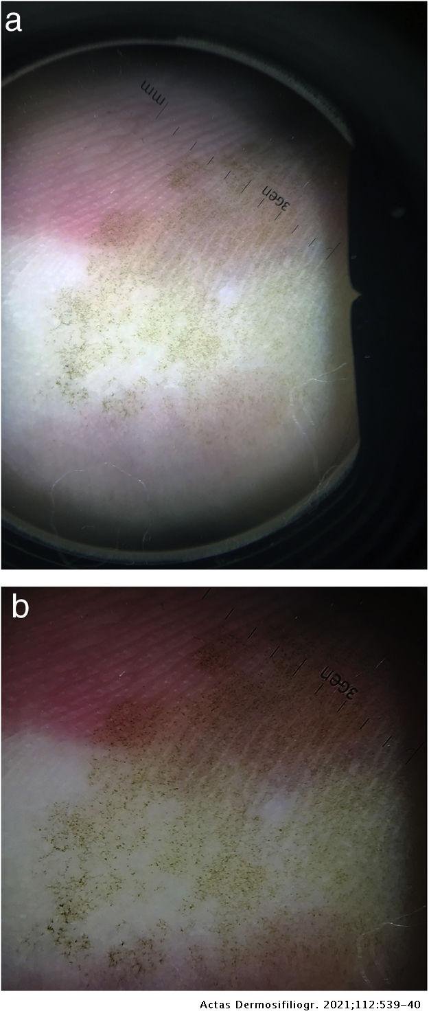Tinea Nigra: Dermoscopic Findings | Actas Dermo-Sifiliográficas