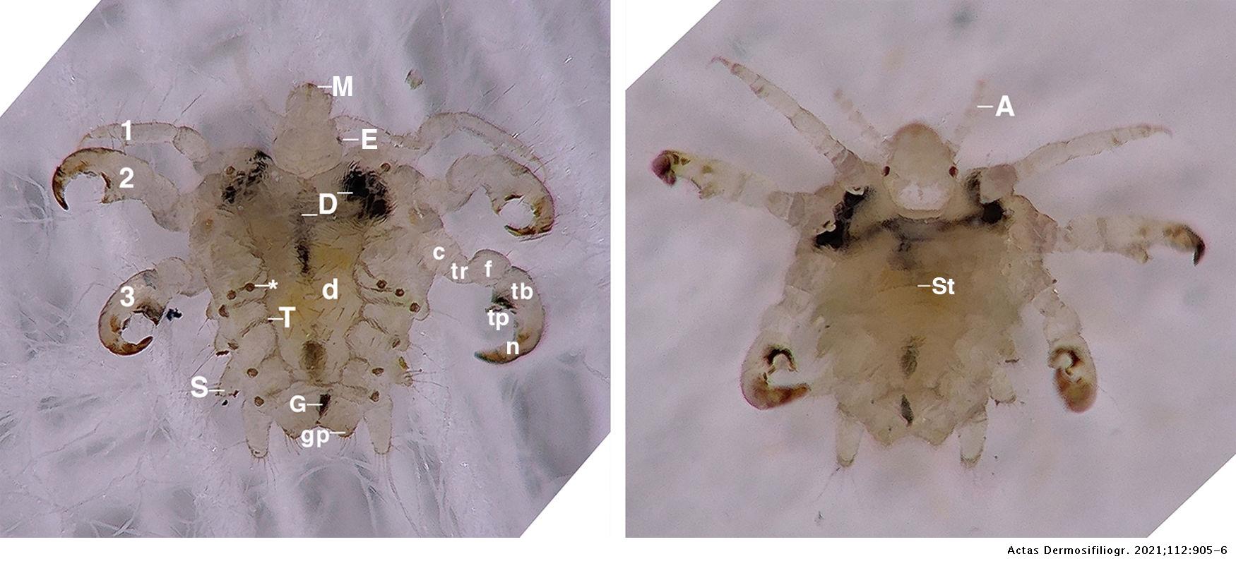 Pthirus pubis Under a Digital Dermoscope Anatomic Description Actas
