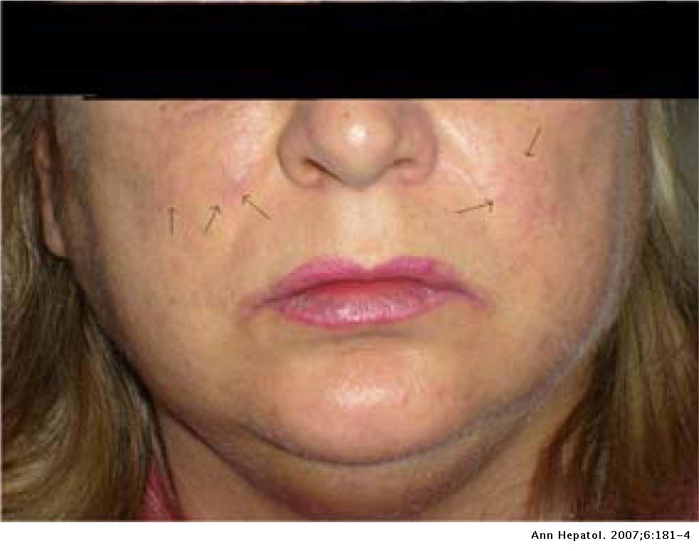 Cirrhosis Of The Liver Skin Rash