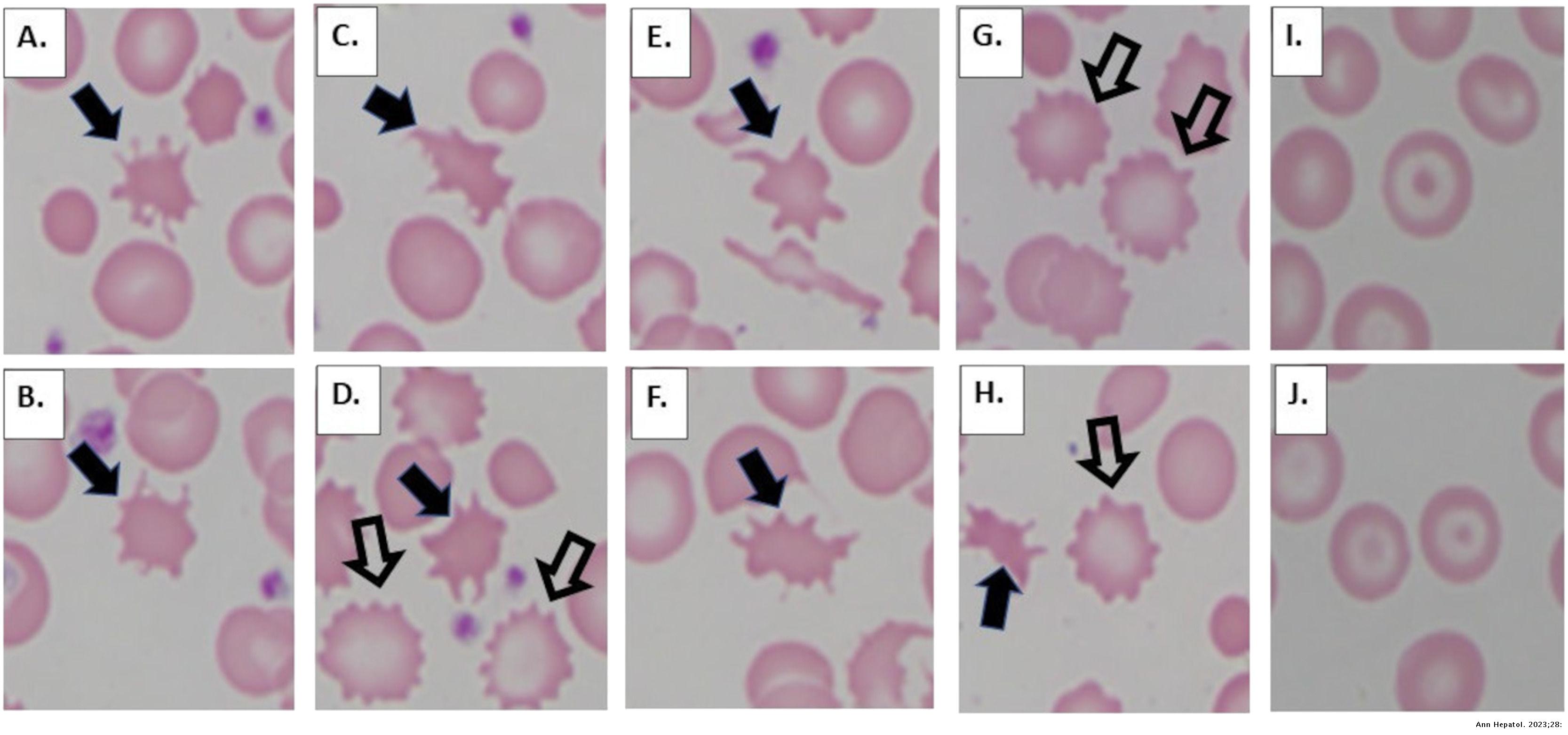 Spur Cells Vs Burr Cells