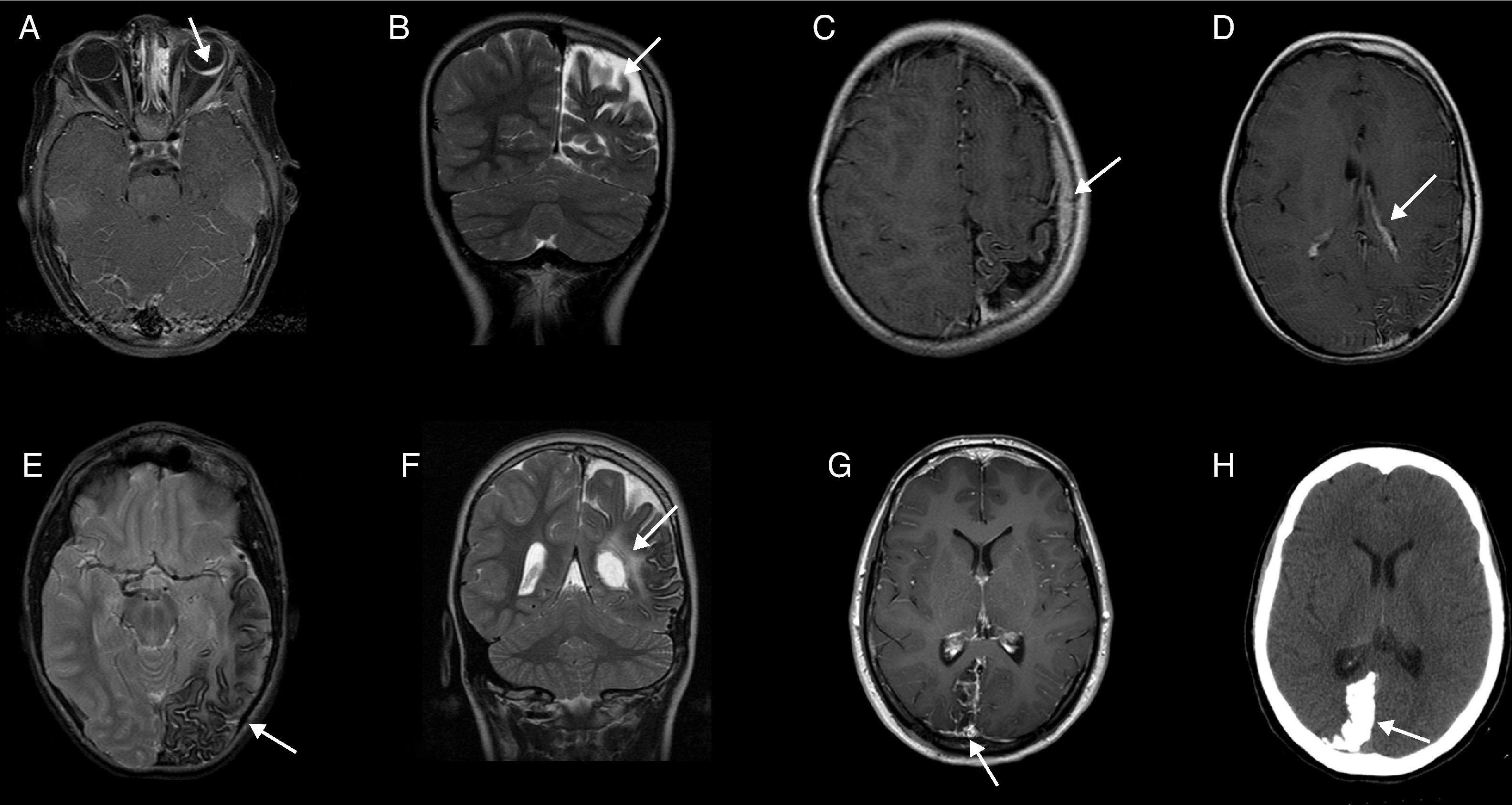 【高尚病例】Sturge-Weber综合征合并癫痫的PET/CT显像1例 - 知乎
