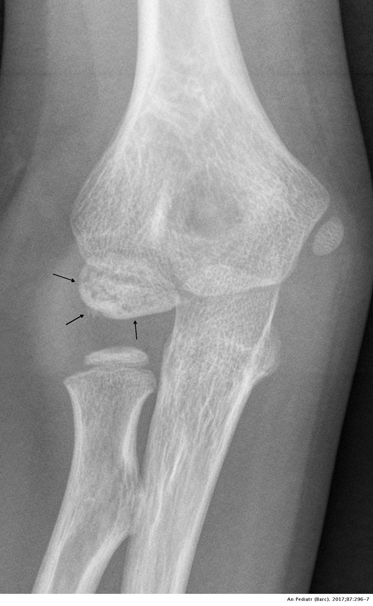 Necrosis avascular del cóndilo humeral: caso clínico-radiológico ...