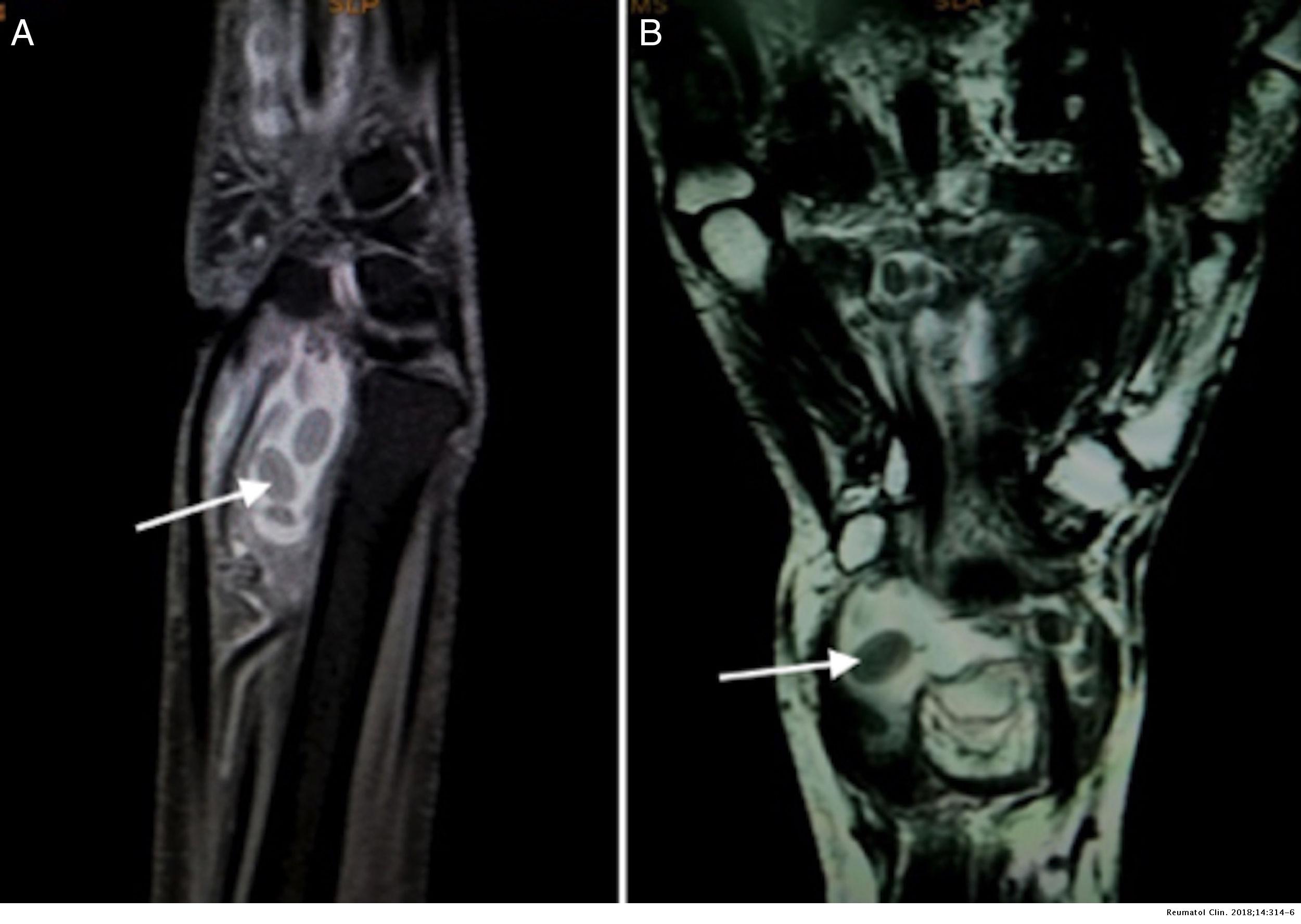 Rice Bodies in Tuberculous Tenosynovitis of Wrist | Reumatología Clínica
