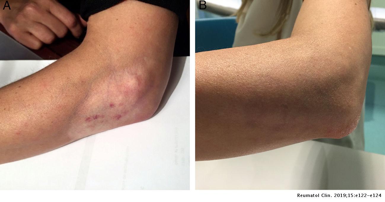 Skin Atrophy From Steroid Injection