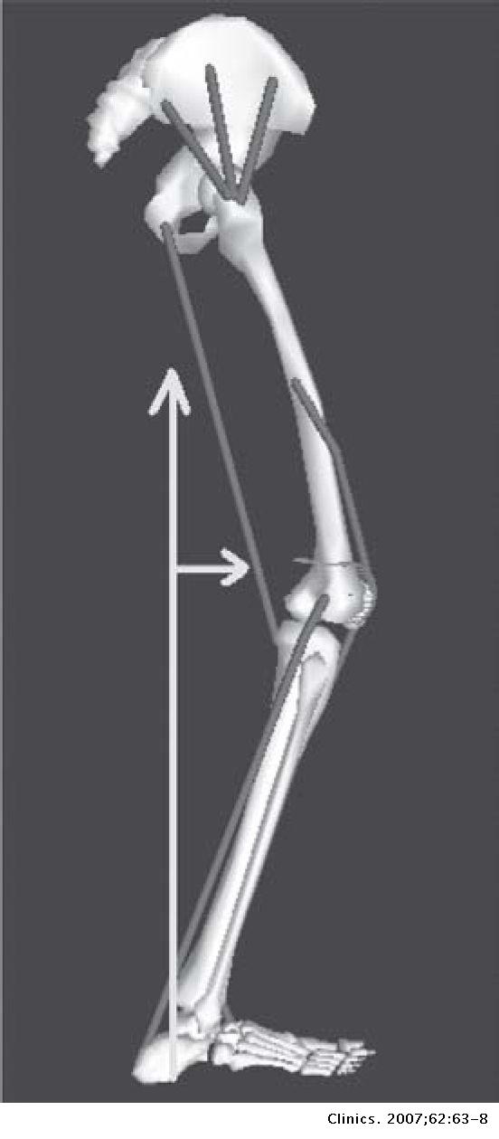 CHANGES IN JOINT KINEMATICS IN CHILDREN WITH CEREBRAL PALSY WHILE ...