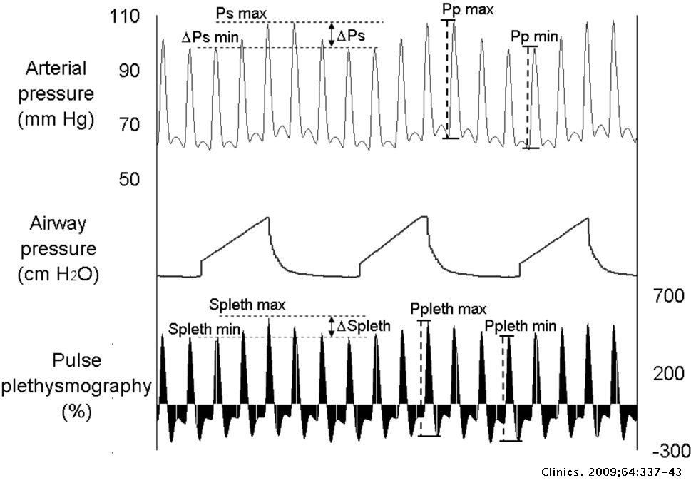 Pulse Oximetry Wave Variation as a Noninvasive Tool to Assess Volume ...