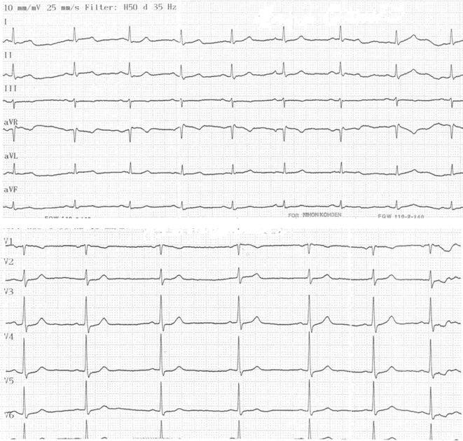 Paroxysmal atrial fibrillation and intermittent left bundle branch