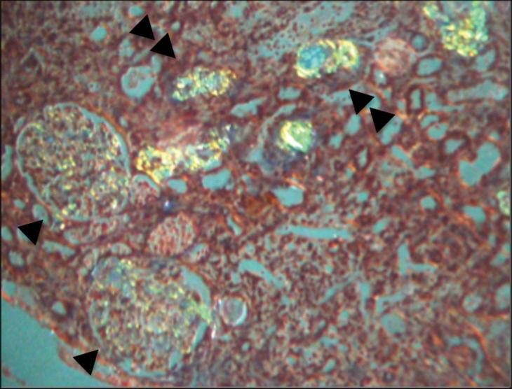 Abdominal Pain Arthritis And Nephrotic Syndrome In A Syrian Patient