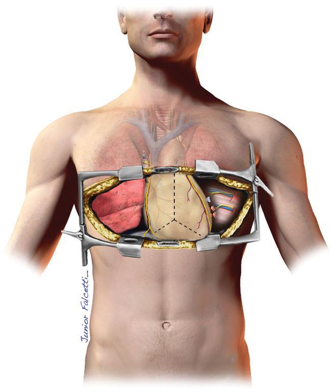 lung-transplant-incision