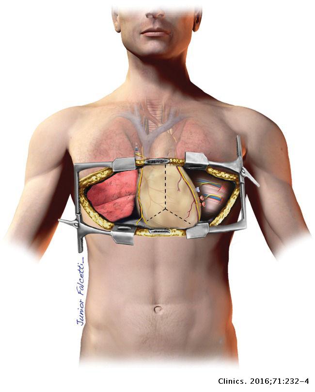 Lung Transplant Incision lung-transplant-incision
