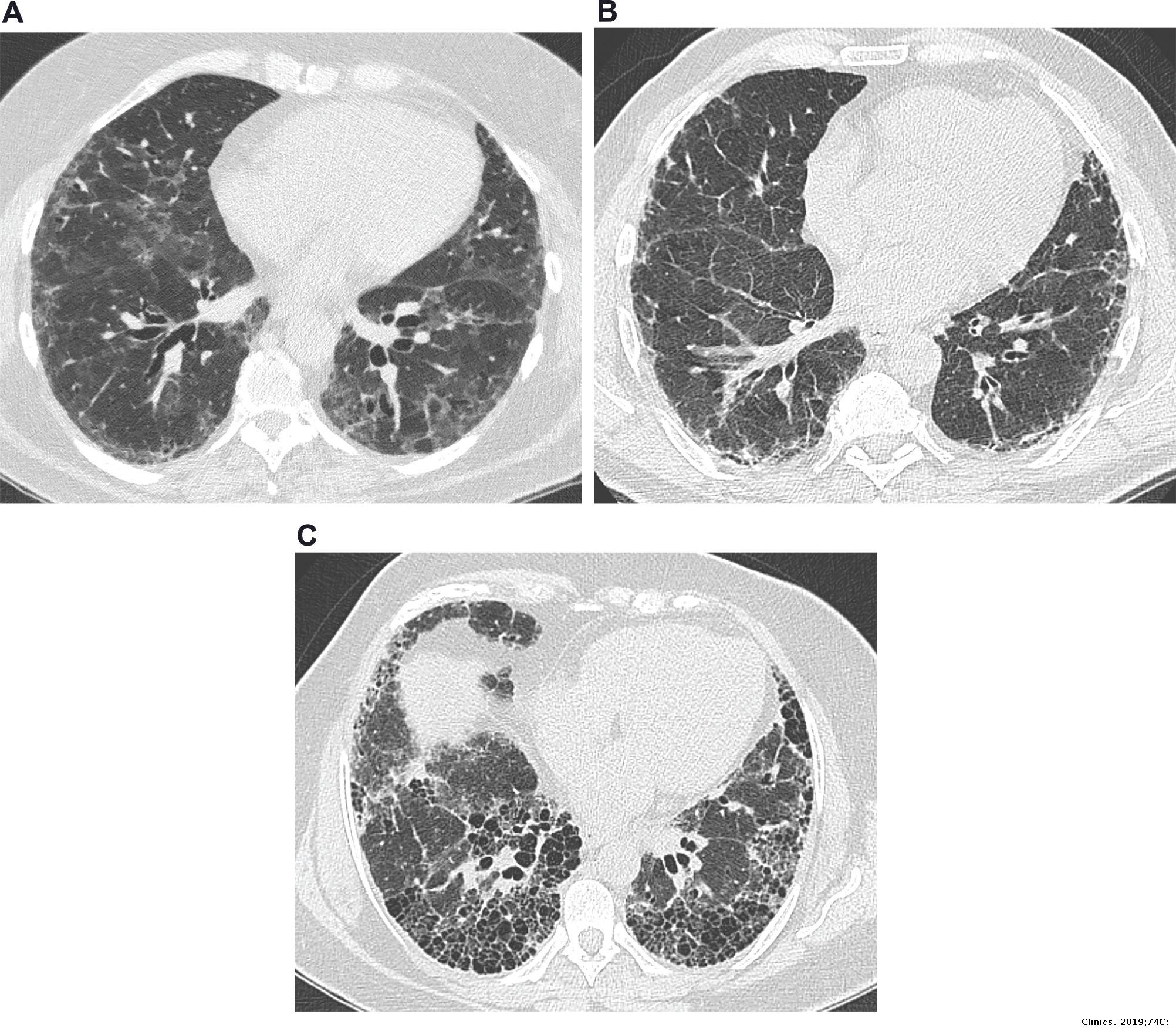 Imaging in idiopathic pulmonary fibrosis: diagnosis and mimics | Clinics