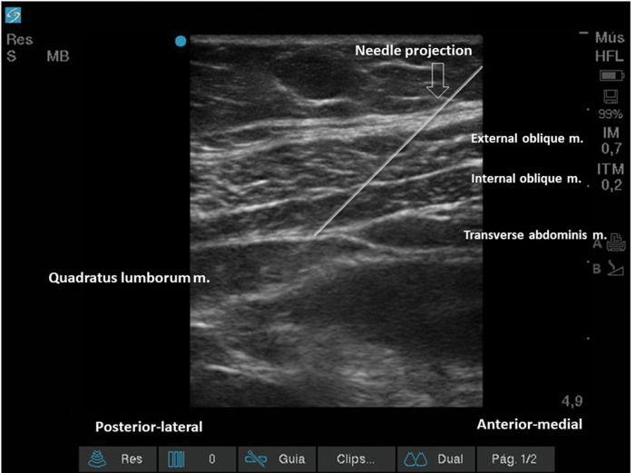 Ultrasound-guided peripheral abdominal wall blocks | Clinics