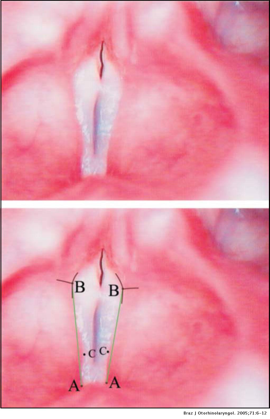 Vestibular fold configuration during phonation in adults with and