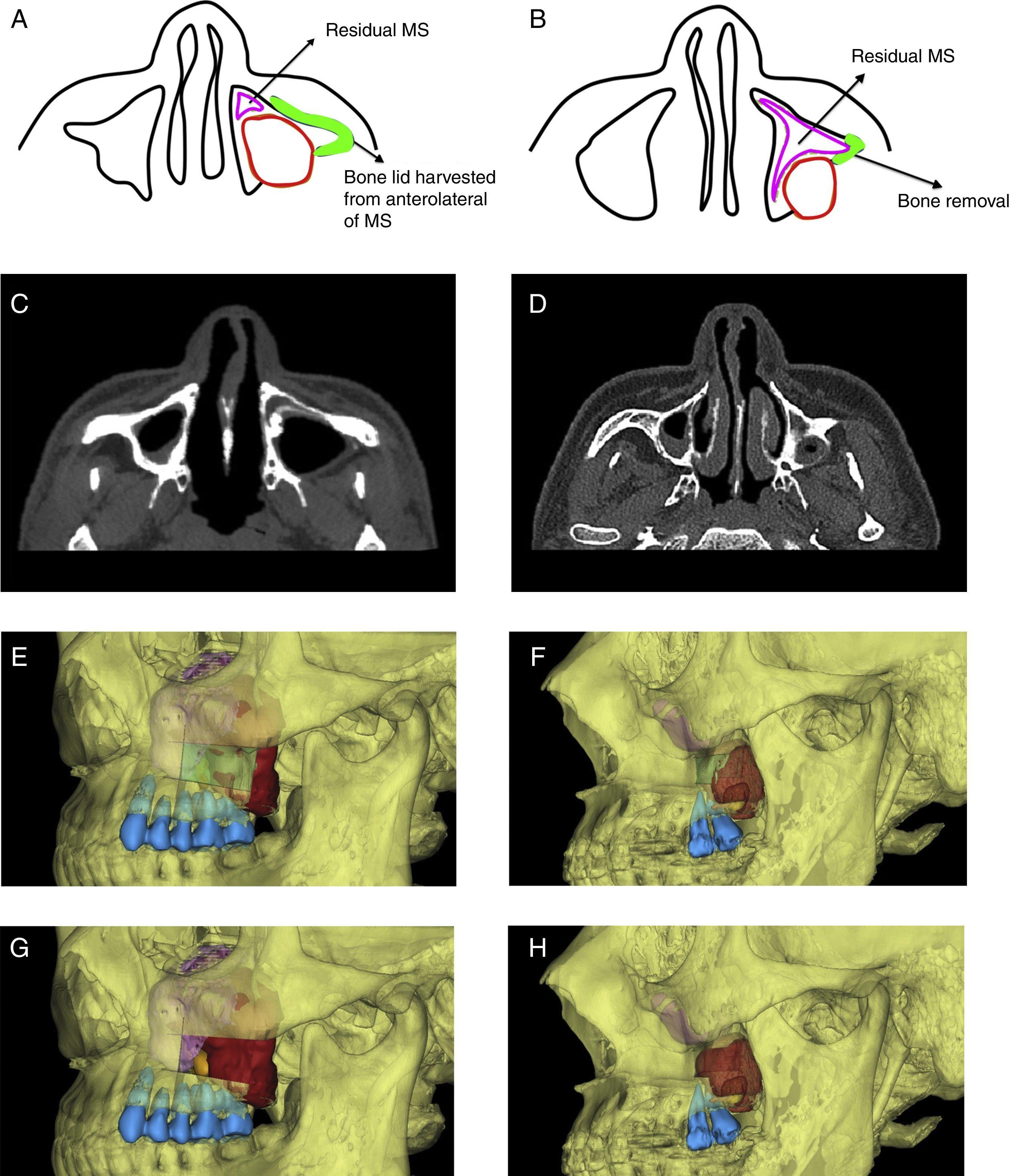 Digital Design Of Functional Surgery For Odontogenic Cyst Intruding