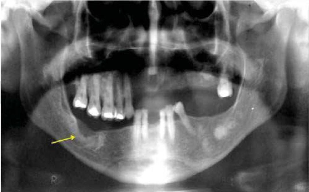 Periapical Cemento Osseous Dysplasia