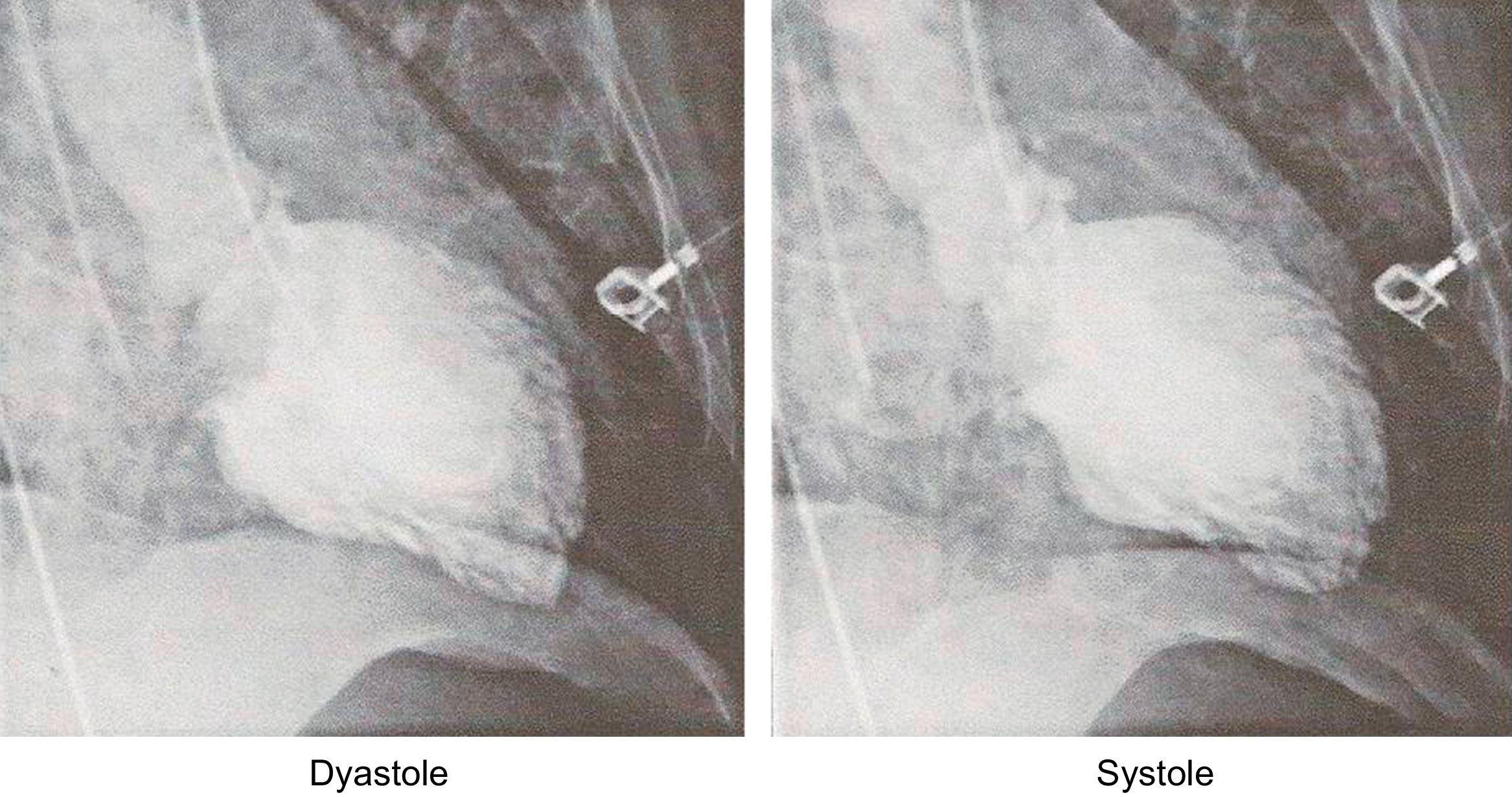 Histologic and Angiographic Imaging of Acute Shock Dengue Myocarditis ...