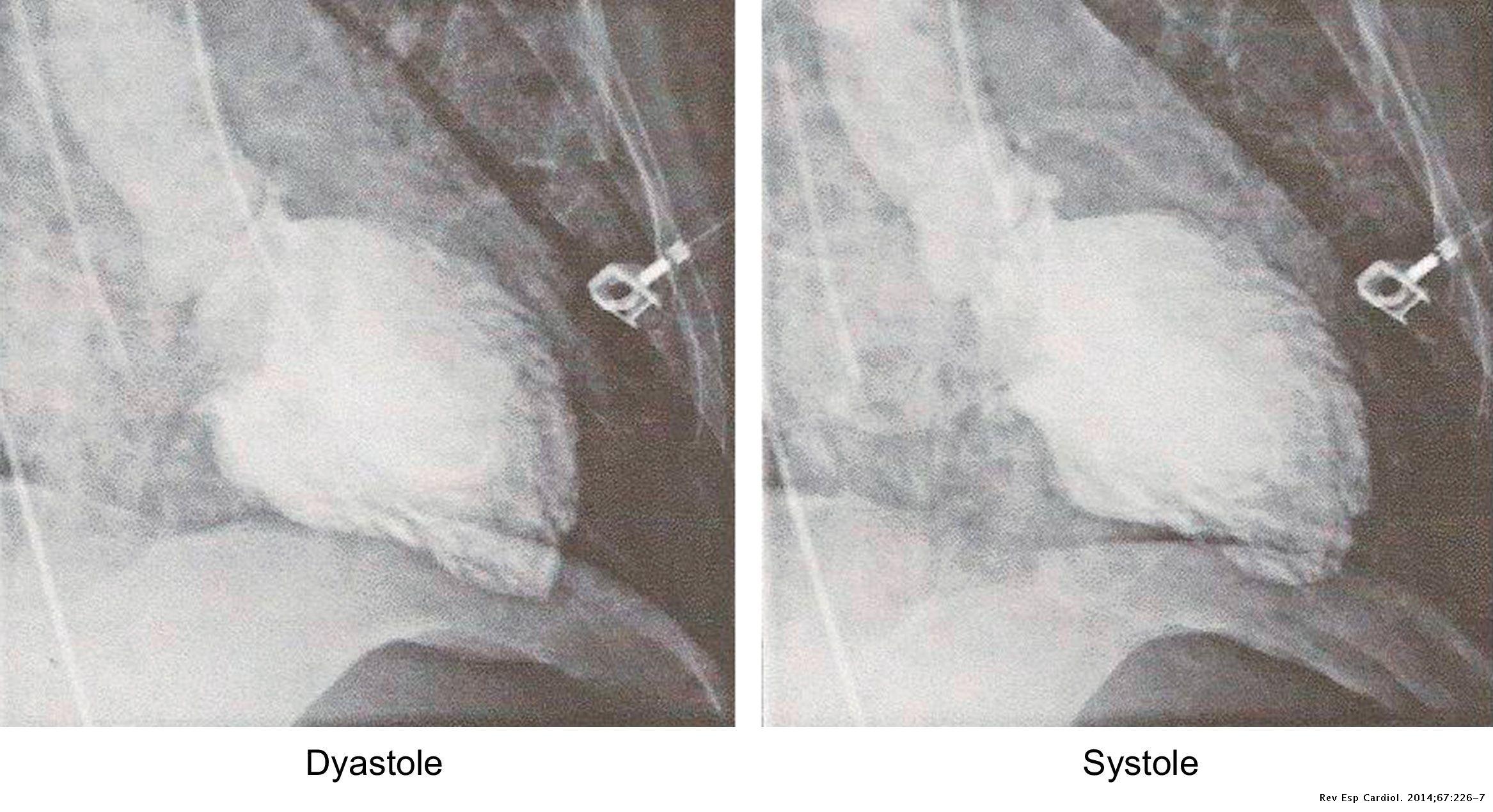 Histologic and Angiographic Imaging of Acute Shock Dengue Myocarditis ...