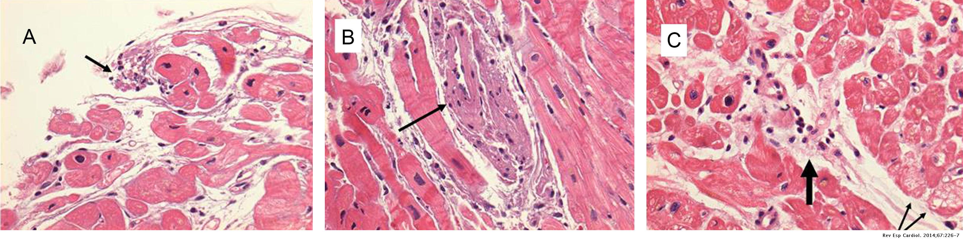 Histologic and Angiographic Imaging of Acute Shock Dengue Myocarditis ...
