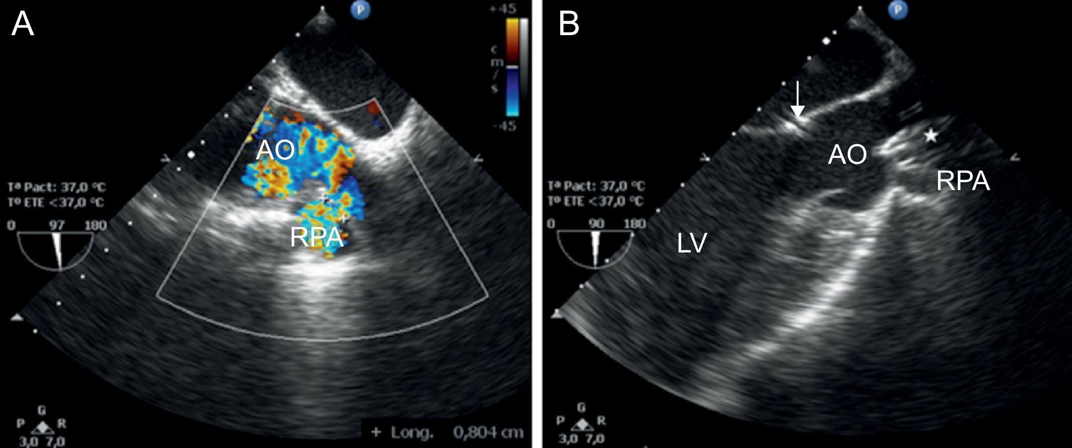 Percutaneous Closure of Iatrogenic Aortopulmonary Fistula Using the ...