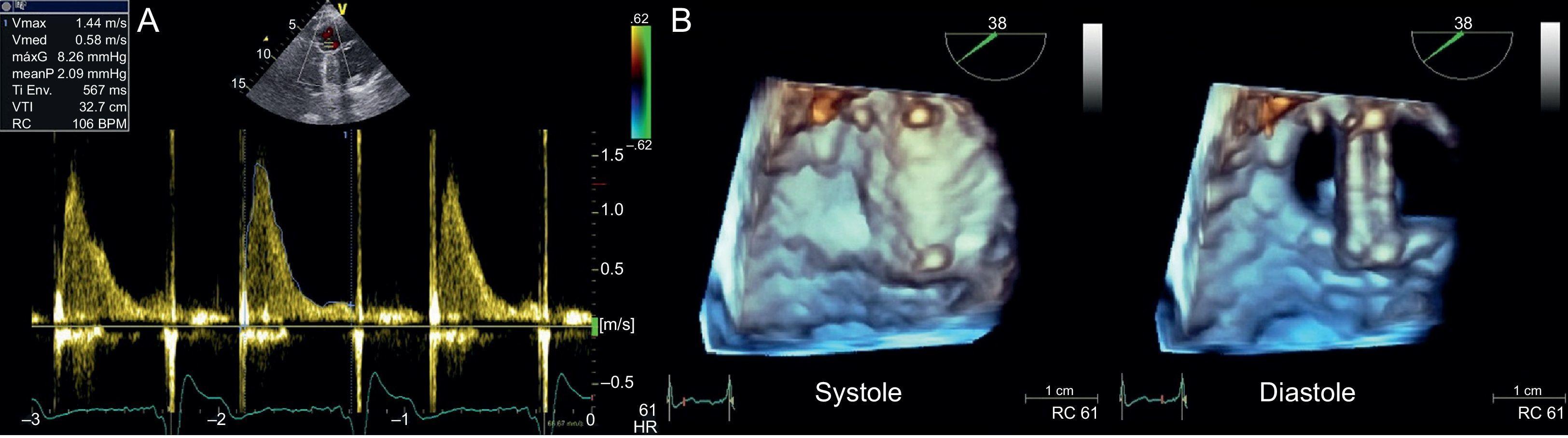Thrombosis Of A Mechanical Tricuspid Valve Prosthesis Resolved With
