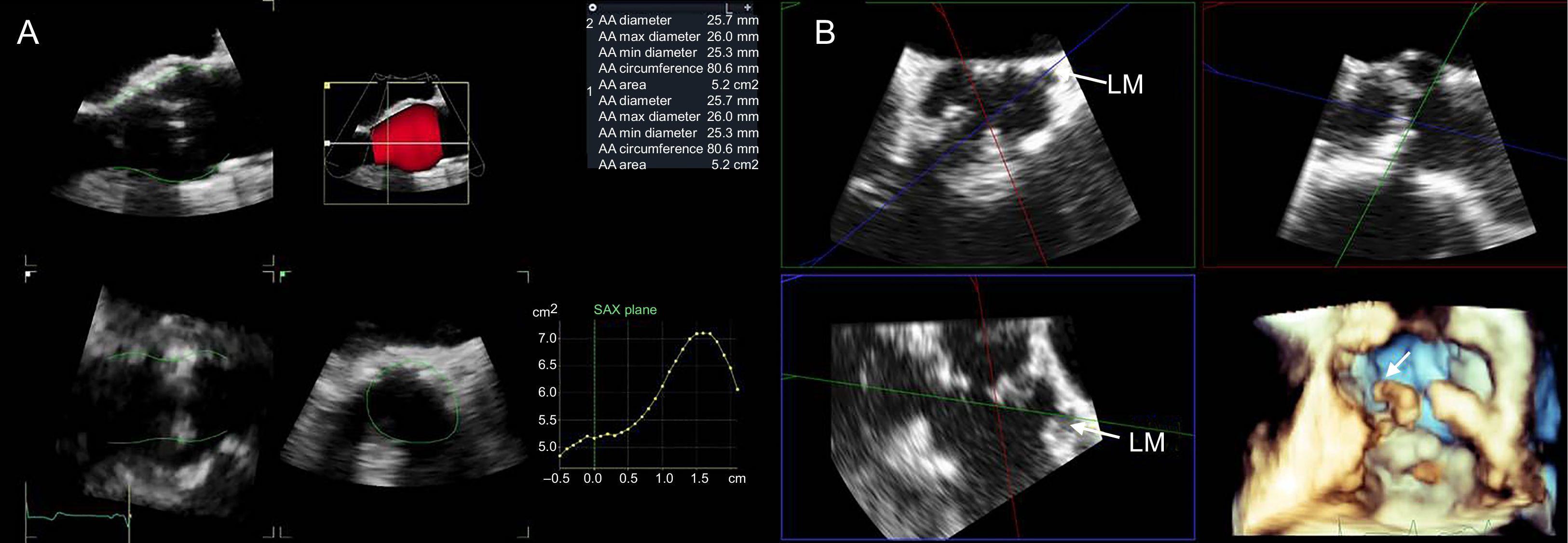 Transcatheter Aortic Valve Replacement: Advantages And Limitations Of ...