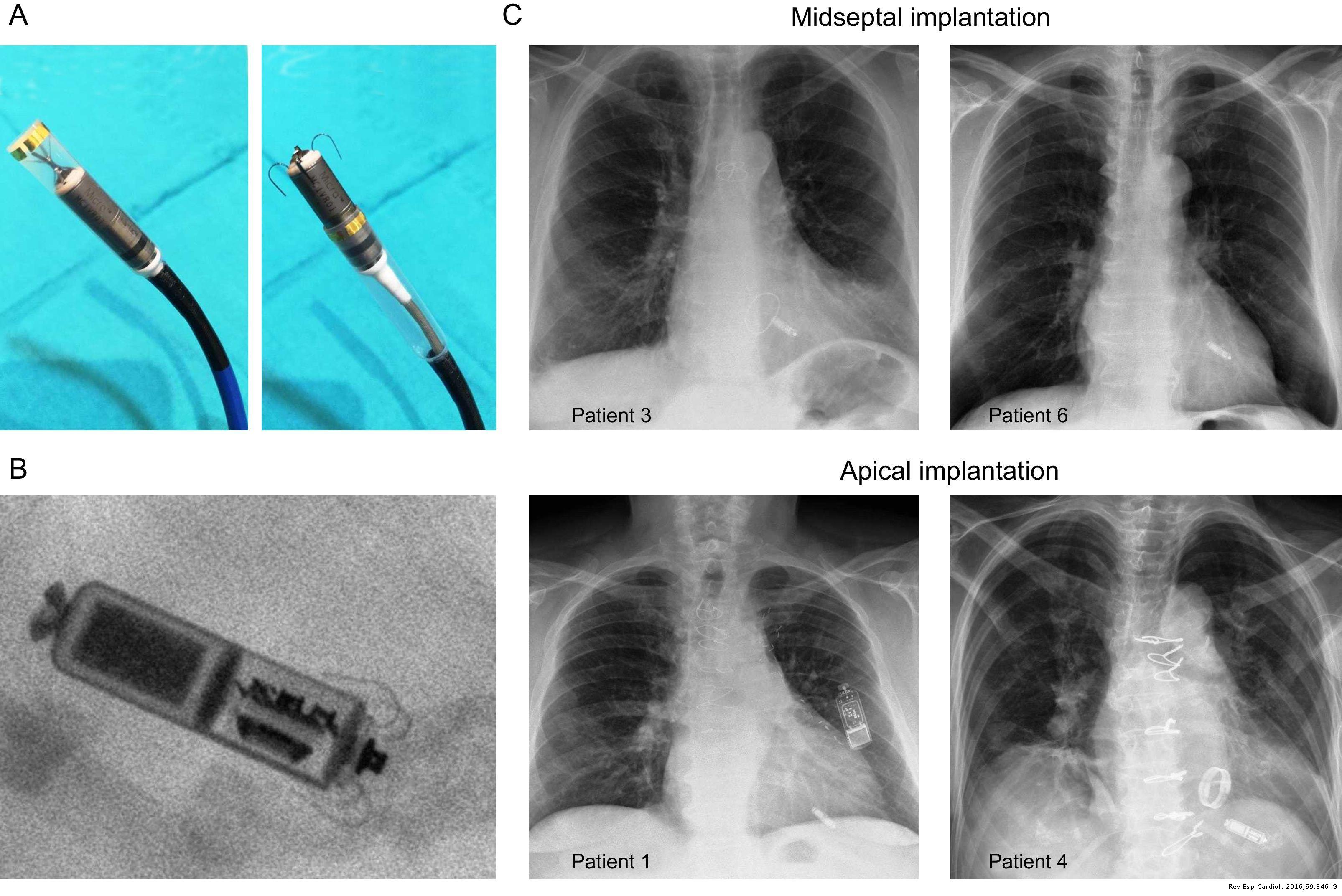 Implantation of the Micra Transcatheter Pacing System: Initial ...