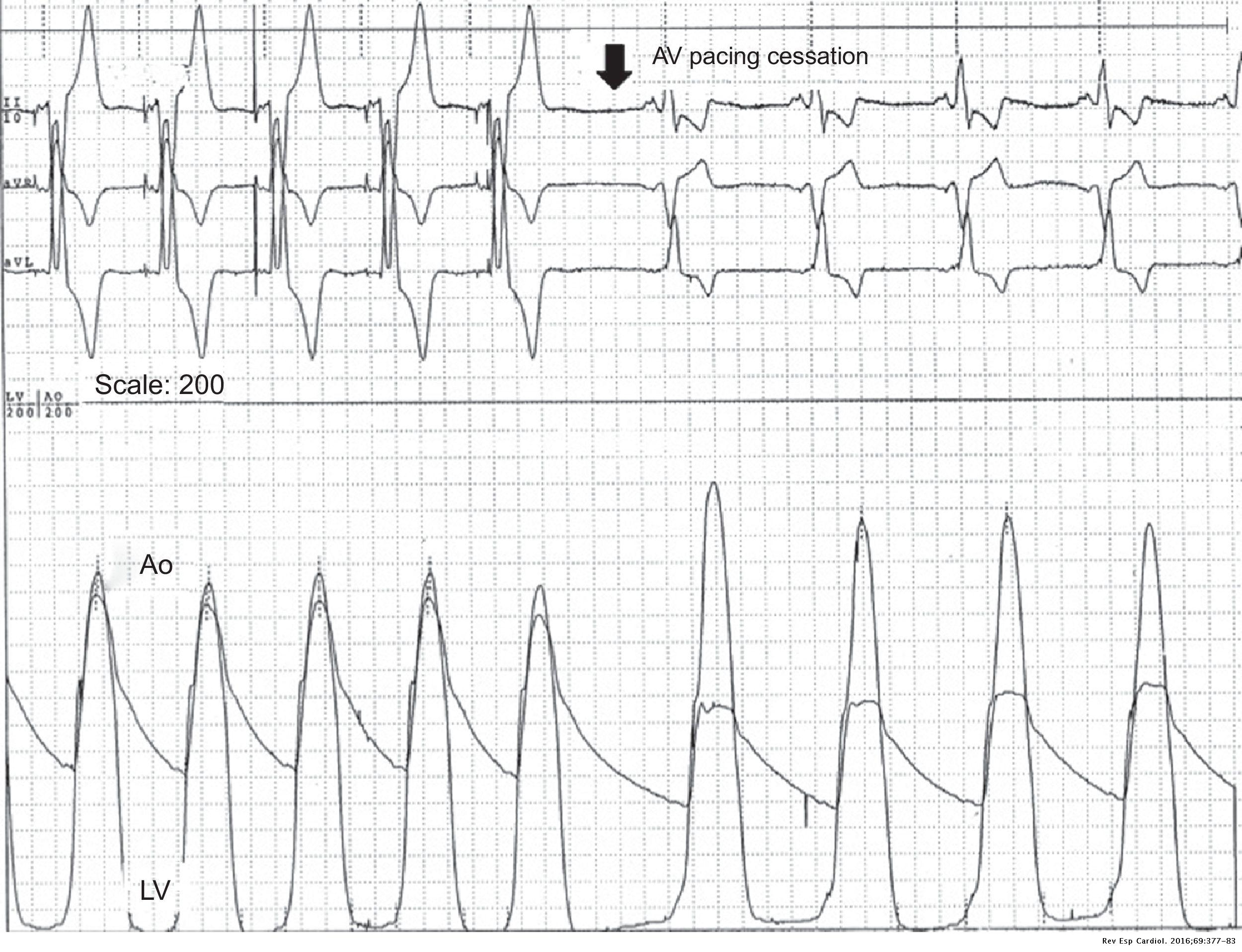 Sequential Atrioventricular Pacing in Patients With Hypertrophic ...