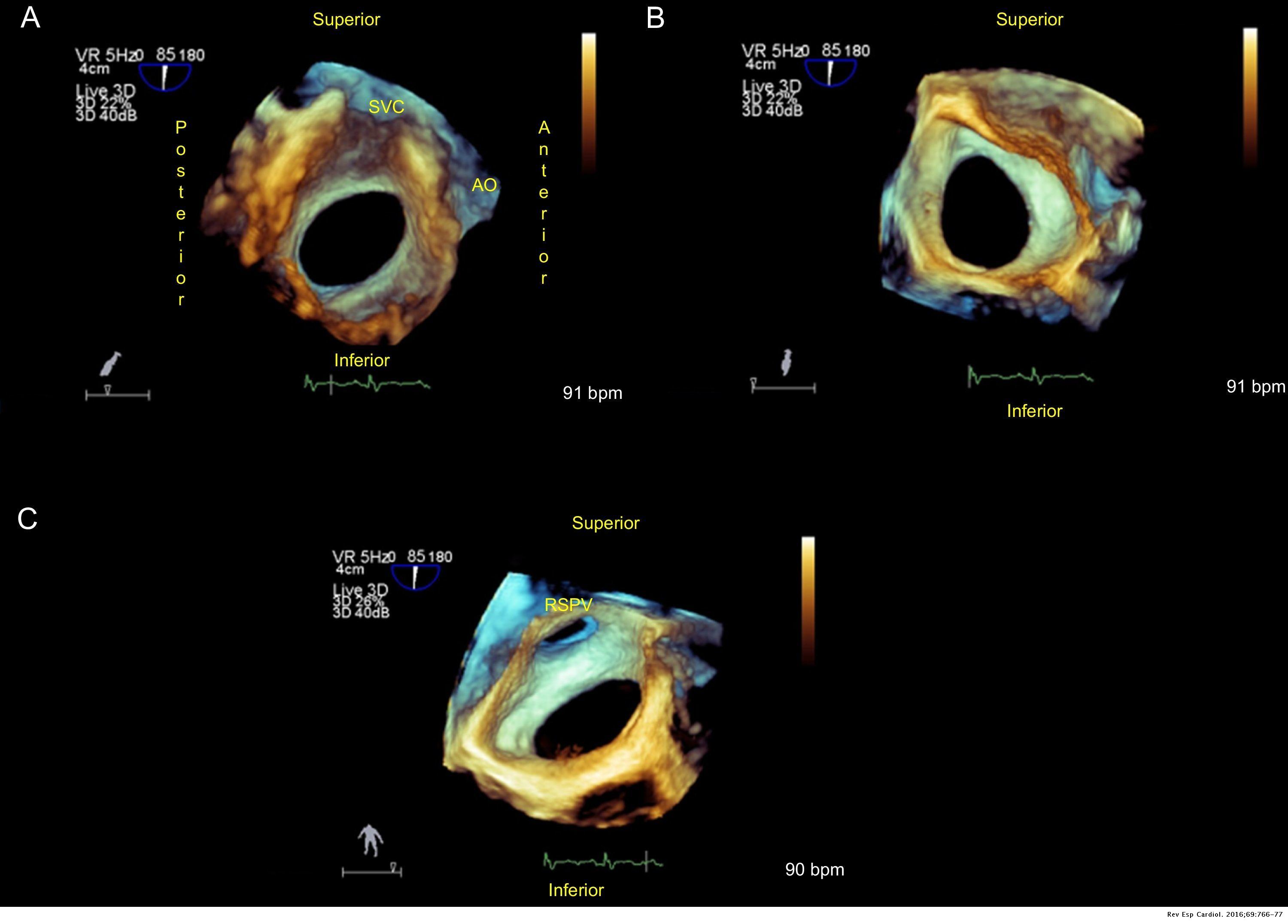 Imaging Techniques in Percutaneous Cardiac Structural Interventions ...