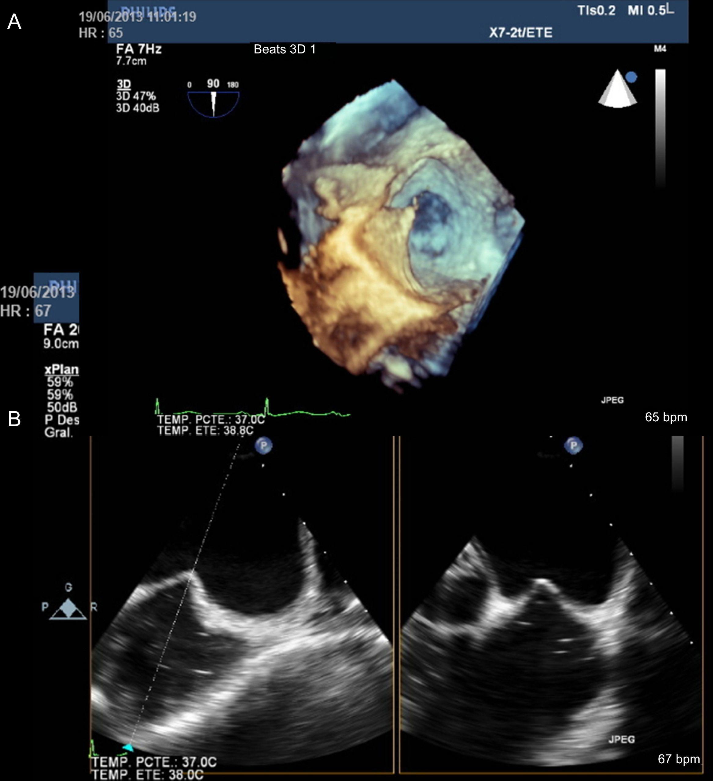 Imaging Techniques In Percutaneous Cardiac Structural Interventions ...