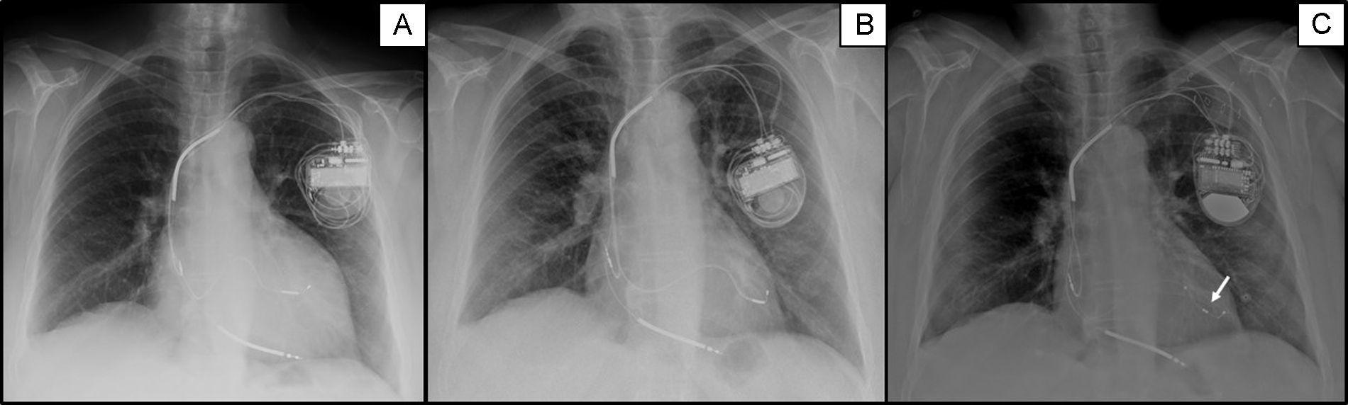 Late Phrenic Nerve Stimulation in a Super-responder to Cardiac ...