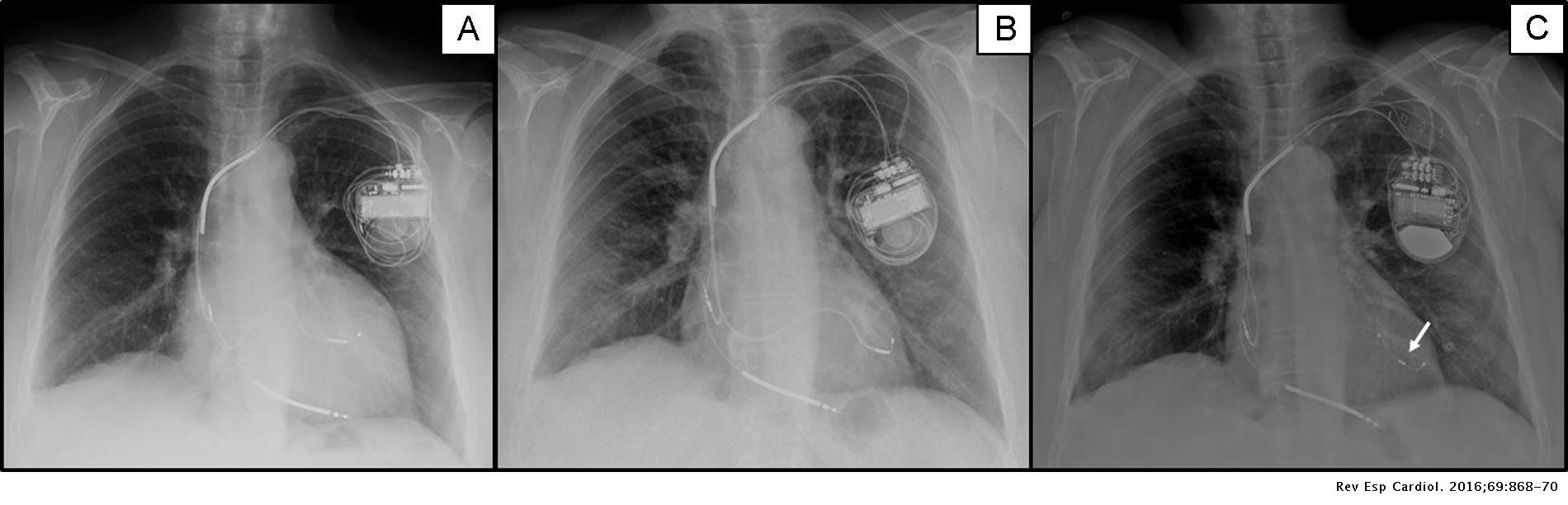 Late Phrenic Nerve Stimulation in a Super-responder to Cardiac ...