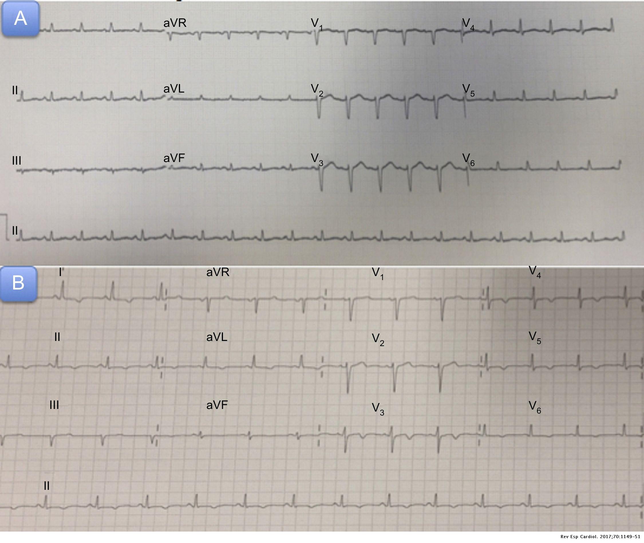 Cardiogenic Shock and Cardiac Tamponade in the Context of Influenza A ...