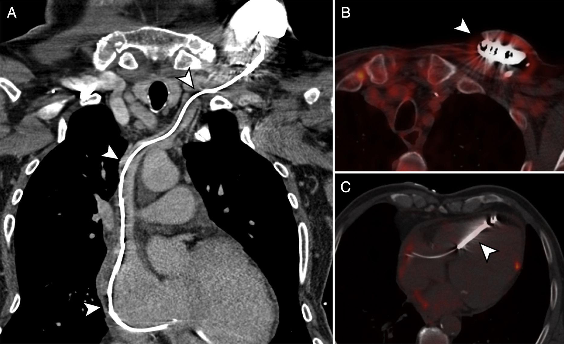 Role of PET/angio-CT in the Evaluation of Intracardiac Devices ...