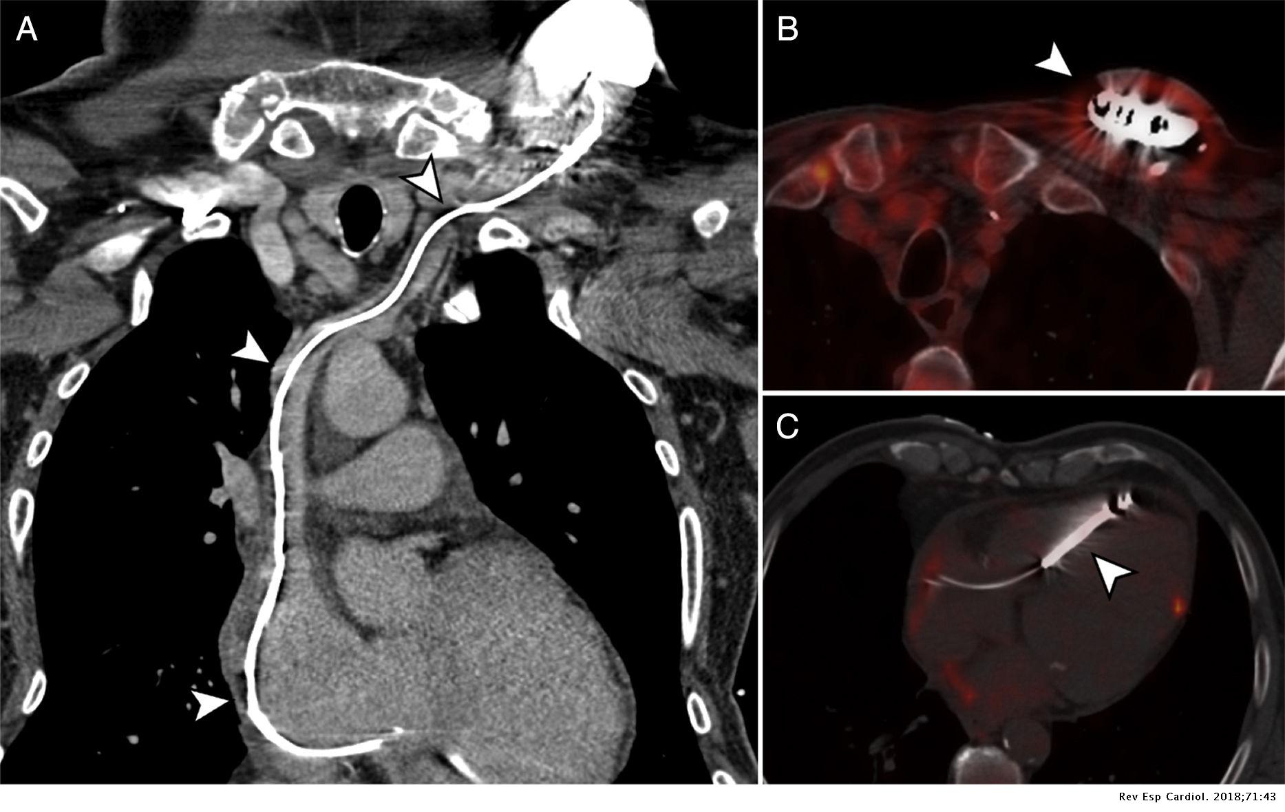 Role of PET/angio-CT in the Evaluation of Intracardiac Devices ...