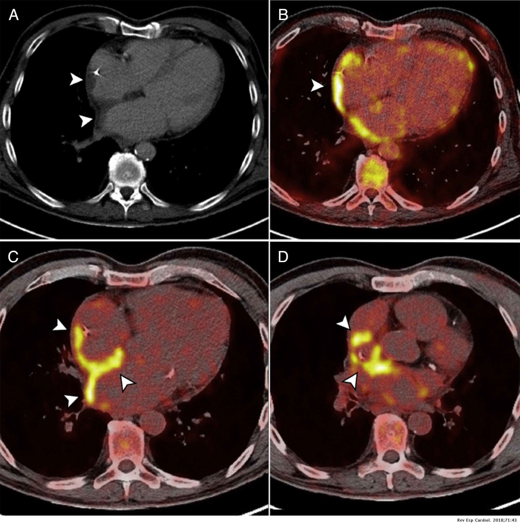 Role of PET/angio-CT in the Evaluation of Intracardiac Devices ...