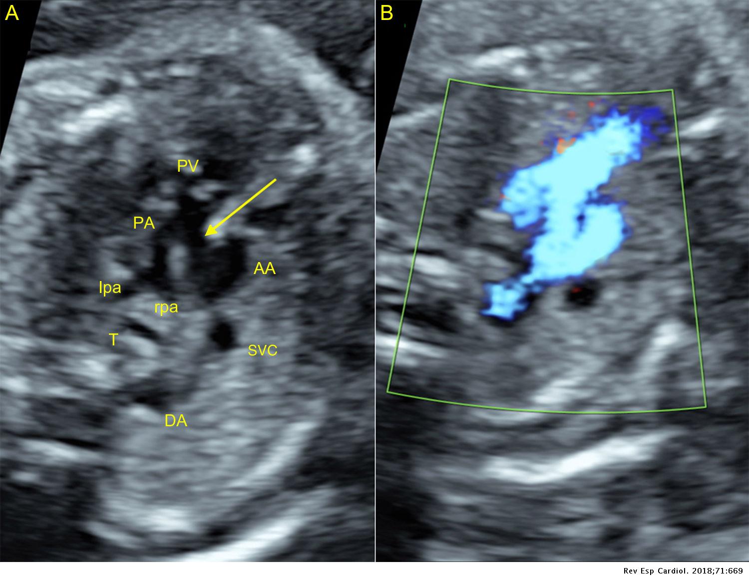 Aortopulmonary Window, Absent Ductus, and Left Subclavian Artery ...