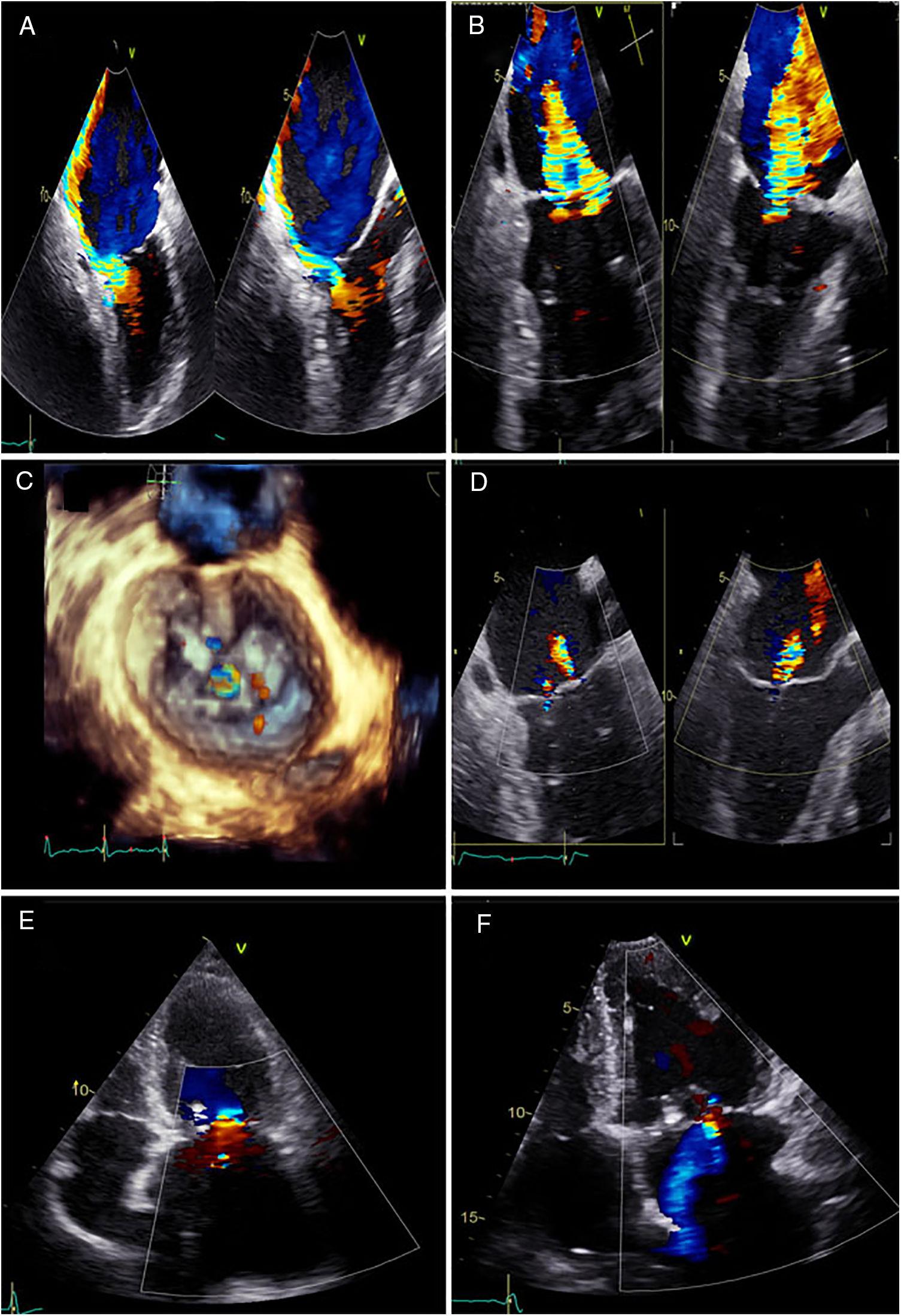 Use of MitraClip in the Percutaneous Treatment of Severe Mitral ...