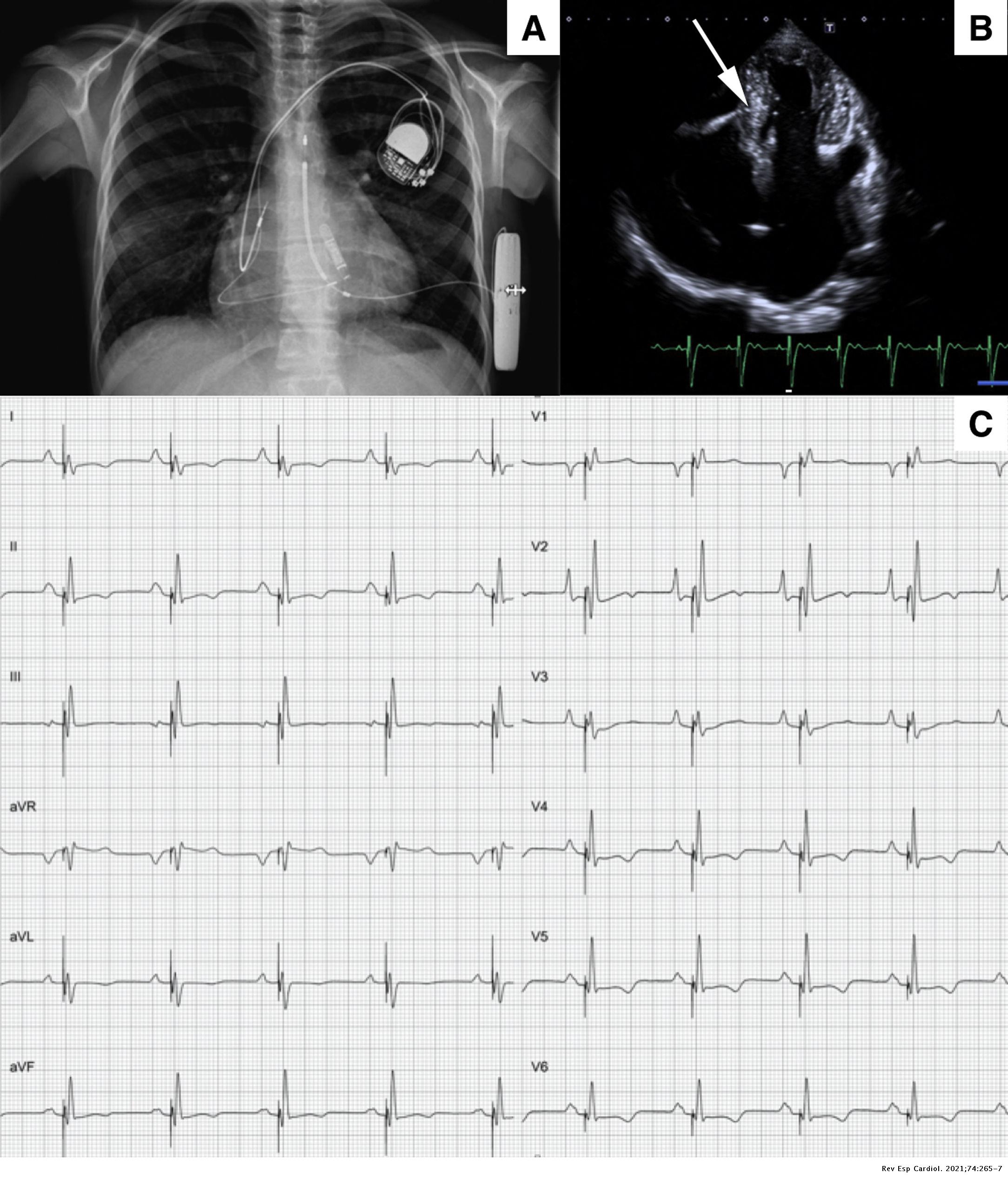 Combined use of subcutaneous implantable defibrillator with endovenous ...